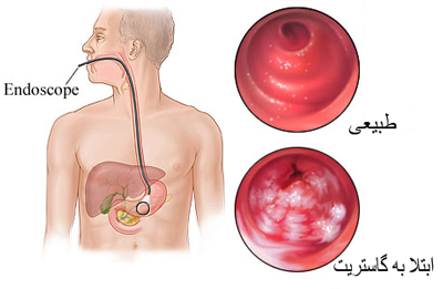 التهاب معده یا گاستریت: چه چیزهایی بخوریم و از چه چیزهایی پرهیز کنیم؟